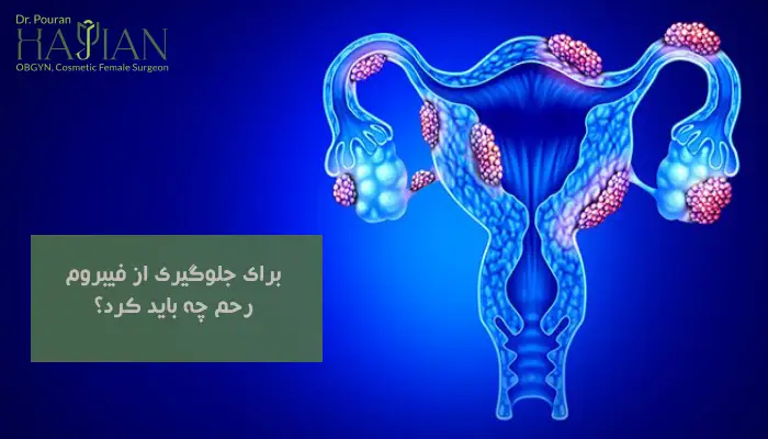 برای جلوگیری از فیبروم رحم چه باید کرد