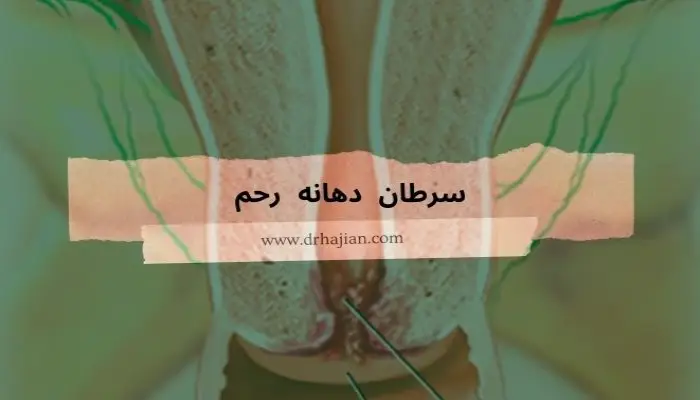 سرطان دهانه رحم چیست