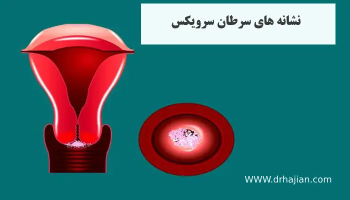 علائم و نشانه های سرطان سرویکس