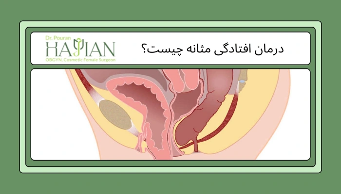 درمان افتادگی مثانه چیست؟