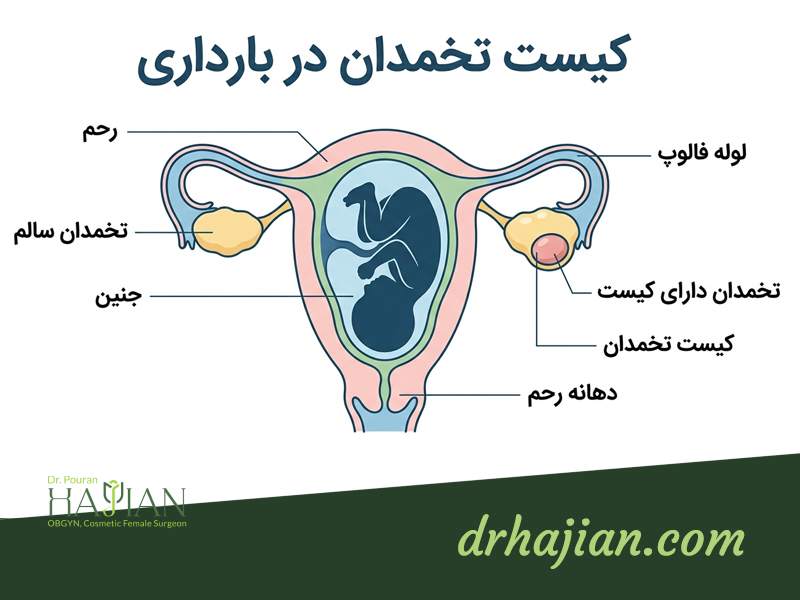 روش درمان کیست تخمدان در بارداری