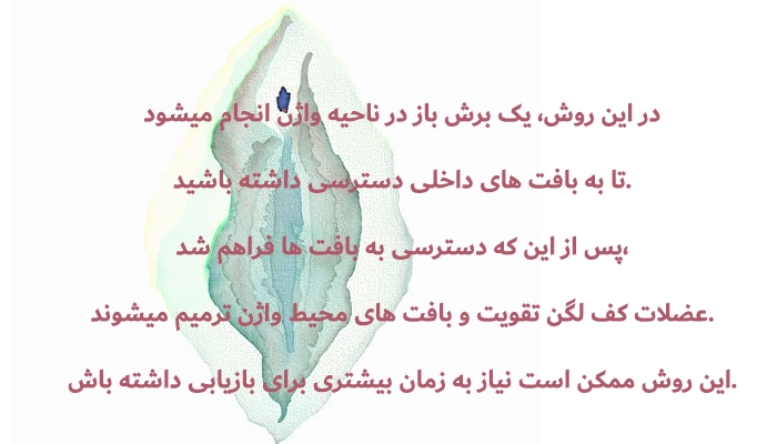 پرینورافی 
