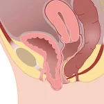 علائم افتادگی مثانه