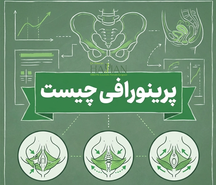 پرینورافی چیست